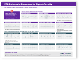 digoxin toxicity ecg reference tool image